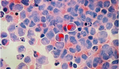 Искусственный интеллект Google и Йеля выдвинул новую гипотезу для лечения рака